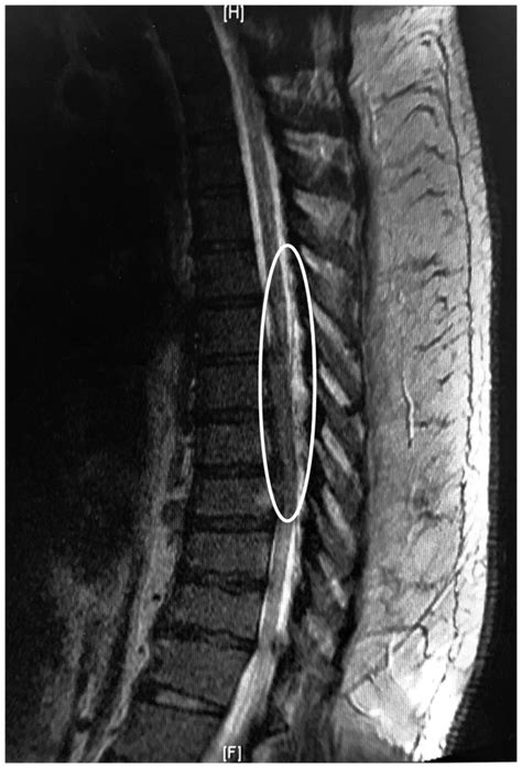 Image Diagnosis Thoracic Epidural Hematoma From A Fall Requiring Emergent Decompressive