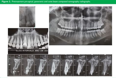 Figure 2 From Miniscrew Assisted Single Tooth Distraction Osteogenesis To Align An Ankylosed