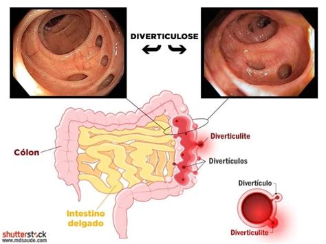 Diverticulosis Y Diverticulitis Qu Es S Ntomas Causas Y Tratamiento