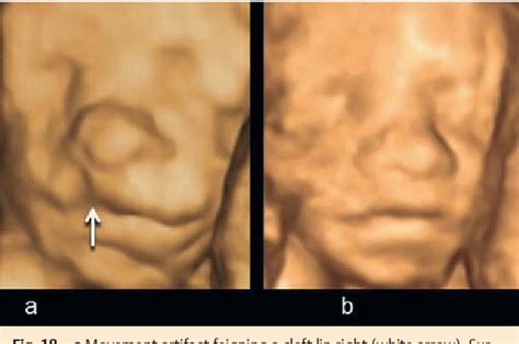 Figure From D Imaging Of The Fetal Face Recommendations From The