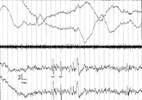 Figure A4 One Epoch 30 S With Vertex Sharp Waves Vsw Typical Vsws