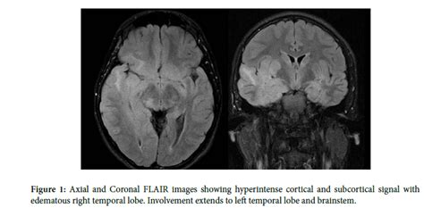 Clinical Neuroimage: Pediatric Gliomatosis Cerebri | International ...