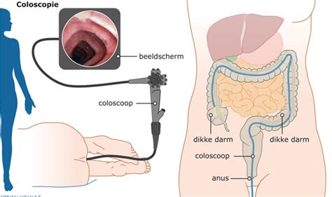 Hoe Lang Duurt Een Maag Darm Onderzoek