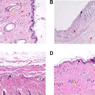 Pathological Section Analysis Of Inflammatory Tissue Around The