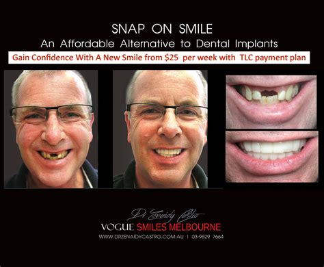 affordable    implant alternative  snap  smile