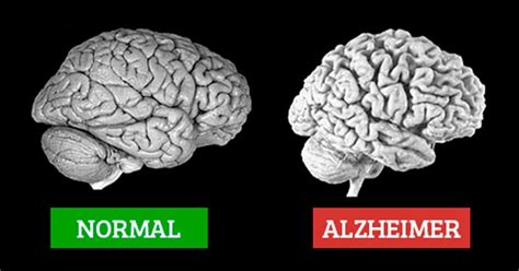 Sintomas De Alzheimer Tua Saúde