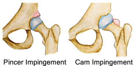 Femoroacetabular Impingement - Rural Physio at Your Doorstep