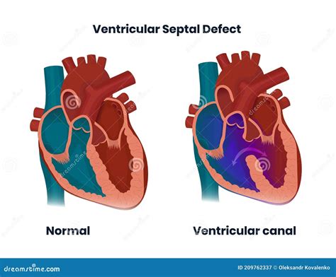 Ventricular Septal Defect With Normal Heart Anatomy Illustration Of