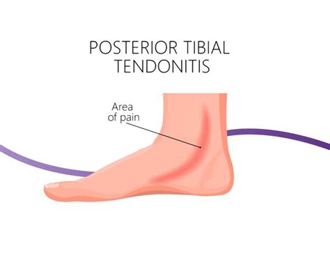 Posterior Tibial Tendon Dysfunction: Causes, Symptoms & Treatment