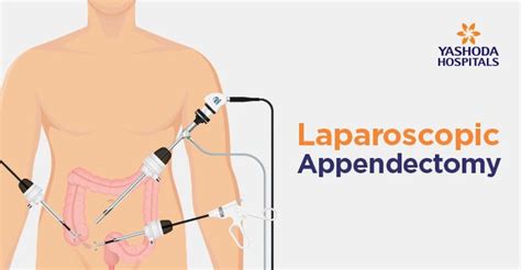 Laparoscopic Appendix Removal Surgery Yashoda Hospital