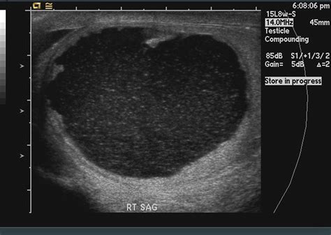 Sagittal View Of Right Testis On Scrotal Ultrasound Download