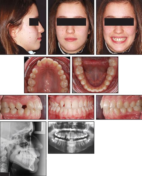 CASE REPORT JCO Online Journal Of Clinical Orthodontics