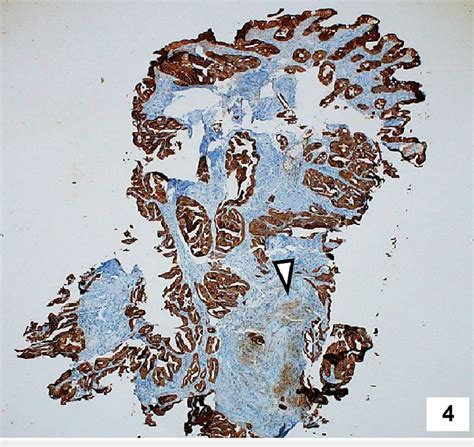 Immunohistochemistry Of The Biopsy Specimen Showing Diffuse Positivity