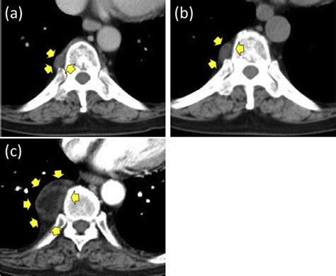 A Chest Ct Shows A Posterior Mediastinal Tumor Yellow Arrows At The