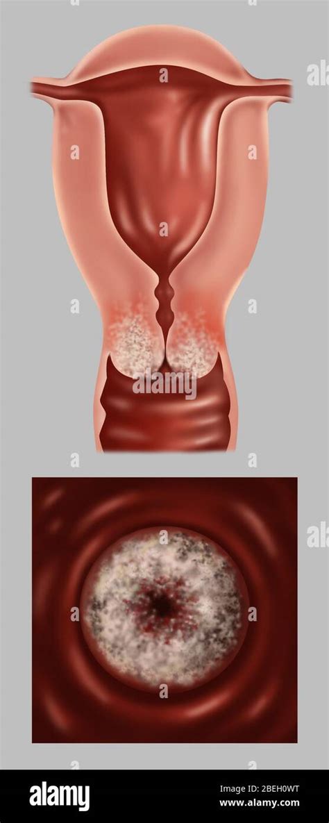 Late Stage Ib Cervical Cancer Hi Res Stock Photography And Images Alamy