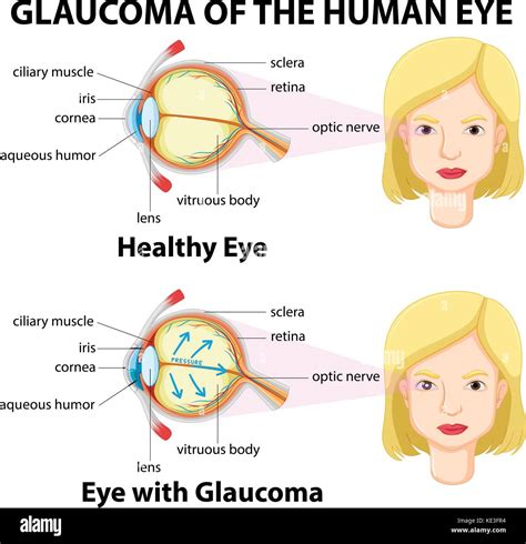 Glaucoma Del Ojo Humano Ilustración Imagen Vector De Stock Alamy