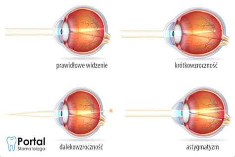 Zaburzenia Widzenia Portal Stomatologa