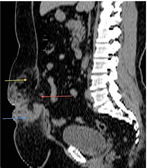 Figure 1 From Metastatic Serous Carcinoma Initially Presented As An