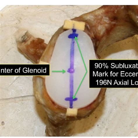 Keeled Left And A Pegged Right Glenoid Component Arthrex Inc Download Scientific Diagram