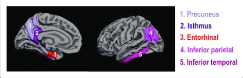 Representation Of The Ad Related Regions Of Interest Three Dimensional