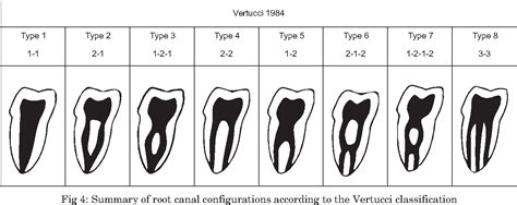 Table 1 from ENDODONTIC TREATMENT OF PREMOLAR WITH UNUSUAL ANATOMY AND HYPERCEMENTOSIS — CASE ...