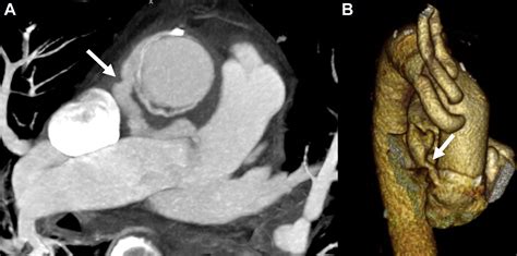 Pseudoaneurysm With An Aortopulmonary Fistula That Appeared Years