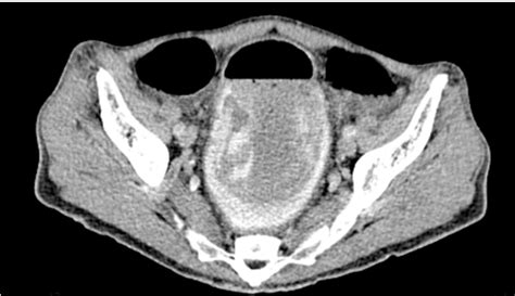 Axial Ct Scan Section Demonstrating Colorectal Intussusception With The