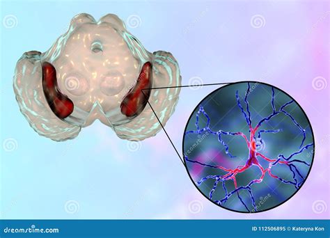 Substantia Nigra In Norm And In Parkinson`s Disease Stock Illustration