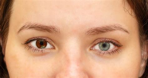 Heterochromia When Does It Occur Types And Causes Nvision