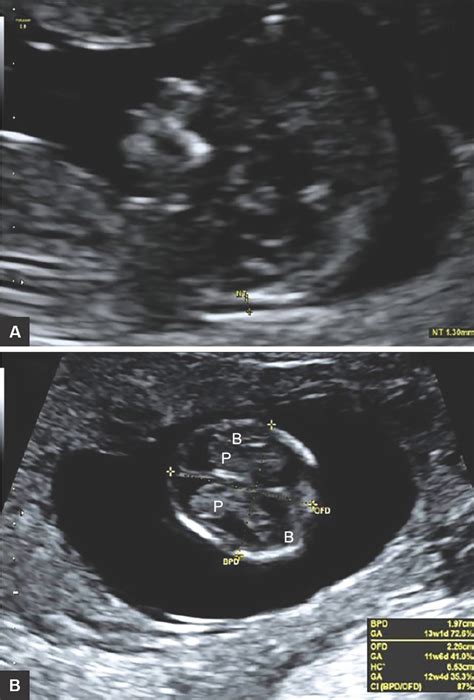 Hydranencephaly Ultrasound