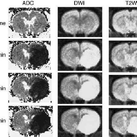 ADC Maps Diffusion And T 2 Weighted Images DWI And T2WI On Slice A