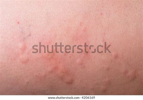 Hives Severe Allergic Reaction Stock Photo (Edit Now) 4206169