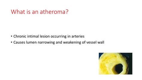 Ppt Atherosclerosis Powerpoint Presentation Id 2352142