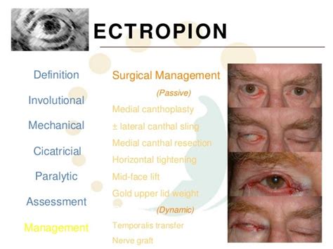 Ectropion