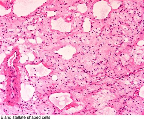 Pathology Outlines Myxoid Liposarcoma