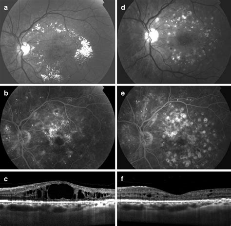 A C Clinically Significant Diabetic Macular Edema D F Six