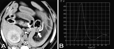 Measurement Of Canine Pancreatic Perfusion Using Dynamic Computed