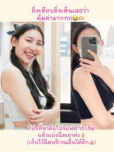 💪เปิดประสบการณ์ ฉีดแฟตที่แขน ลดเร็วจริงหรือหลอก⁉️ แกลเลอรีที่โพสต์โดย Mega Beauty Lemon8