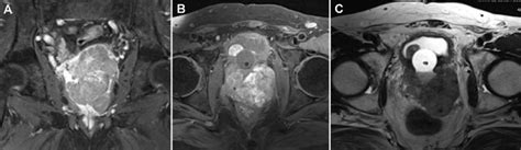 Dynamic Contrast Enhanced Mri Images Showing A Large 8 2 Cm Â 6 3 Cm Â