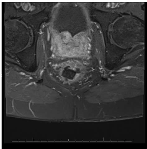 Adenocarcinoma Involving The Urinary Bladder Bmj Case Reports