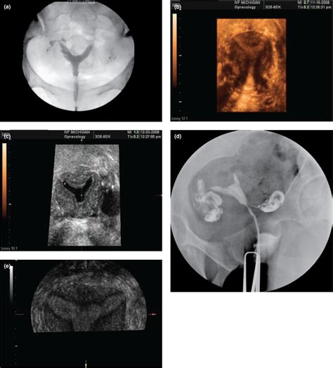 Retroverted Uterus Hsg