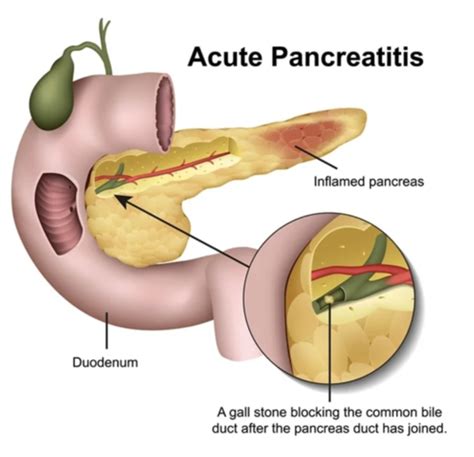 Clin Med Gi Biliary Pancreatic Hepatic Flashcards Quizlet