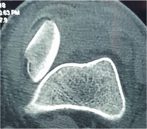 Ct Scan Shows The Medial Eversion Dislocation Of The Patella