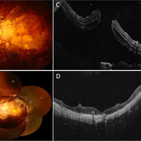 Color Fundus Photographs Showing Posterior Pole With Retinal Detachment Download Scientific