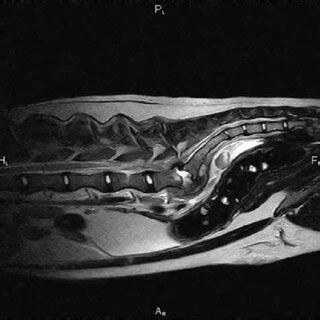 Sagittal T2 Weighted Magnetic Resonance Image Of The Lumbosacral