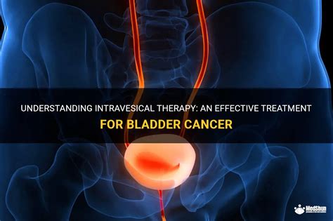 Understanding Intravesical Therapy An Effective Treatment For Bladder