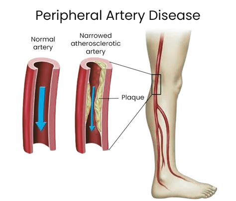 Peripheral Artery Disease Pad Conditions Downtown Vein And Vascular