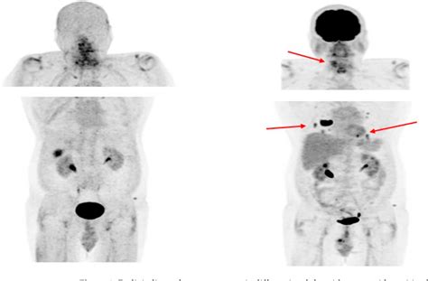 Pdf Molecular Theranostics In Radioiodine Refractory Differentiated