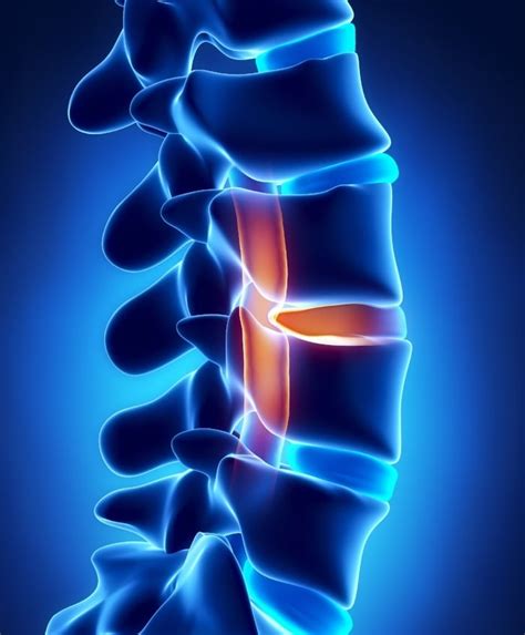 Sacral Spine S1 S5 Injuries Sacral Sparing