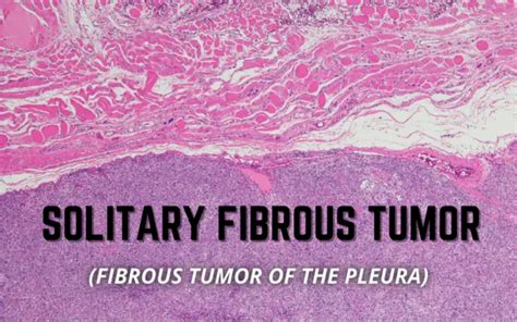 Solitary Fibrous Tumor Key Symptoms That Signal A Check Up